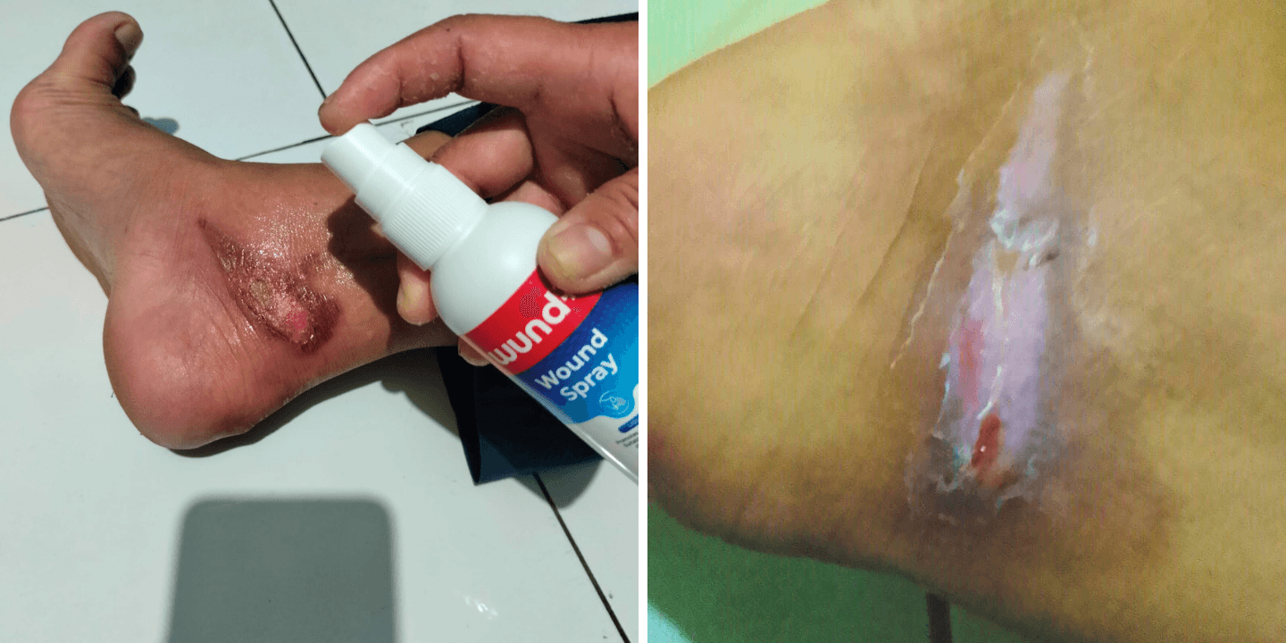 Faster Burn Recovery with wund+™ Wound Spray