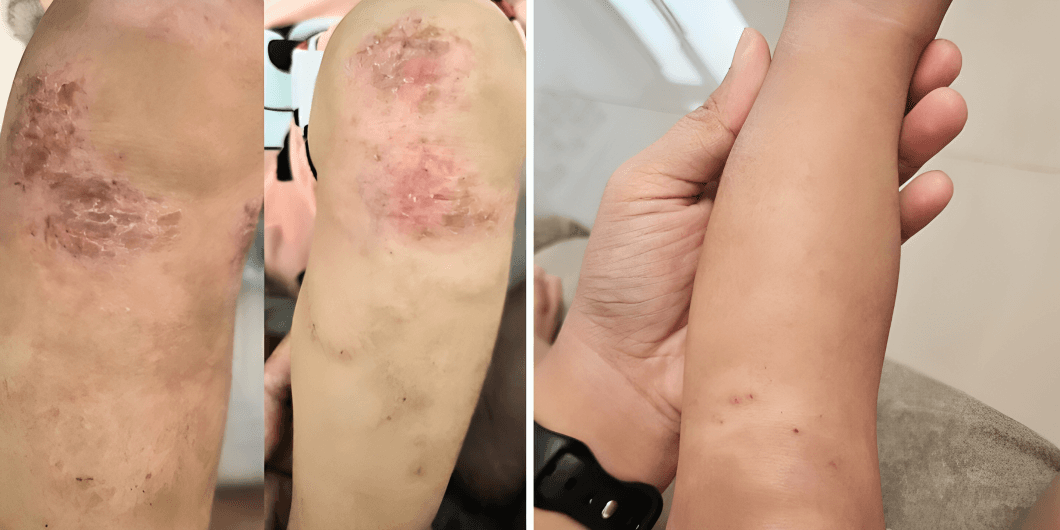 wund+™ Wound Spray Makes Baby Wound Care So Much Easier