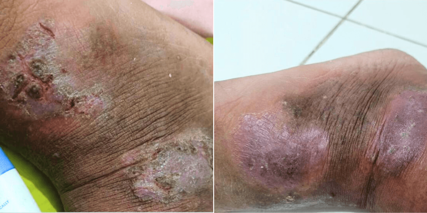 Efektif Tangani Eksim pada Kulit Diabetik dengan wund+™ Regeneration Cream