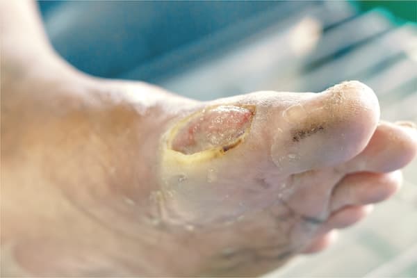 <p>Penderita diabetes mengalami perbaikan kulit yang terlihat dalam satu jam setelah menggunakan <strong><span data-color="brand" class="color" style="--color: brand; --dark-color: brand">wund+™ </span>Regeneration Cream </strong>dengan formulasi khusus kondisi kulit diabetik.</p>