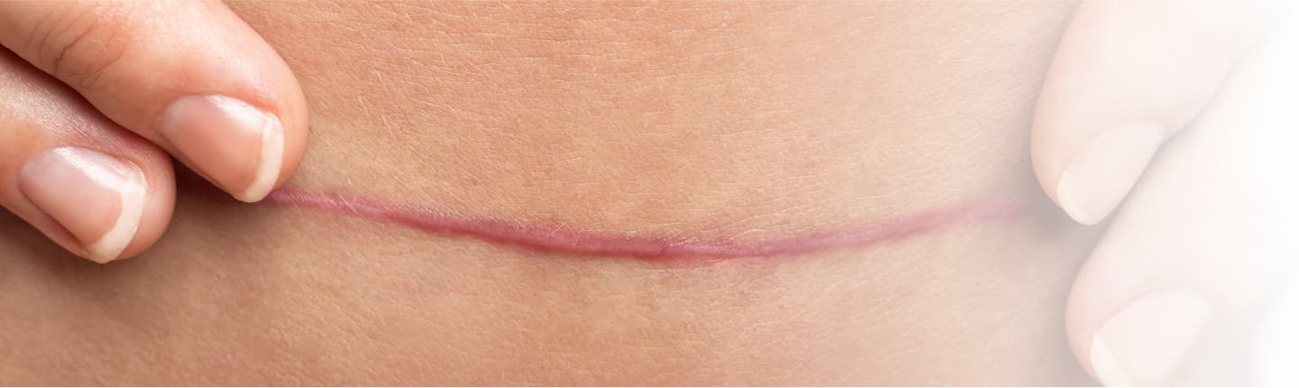 <p>Kelebihan<br>[wund] Scar Gel</p>