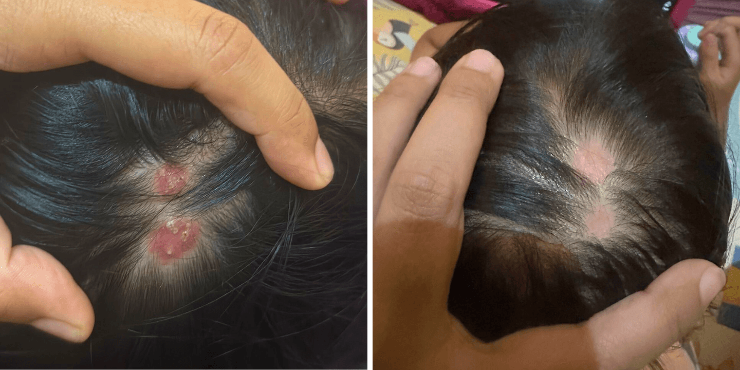 Fast Recovery from Scalp Wound in Children with wund+™ Wound Spray