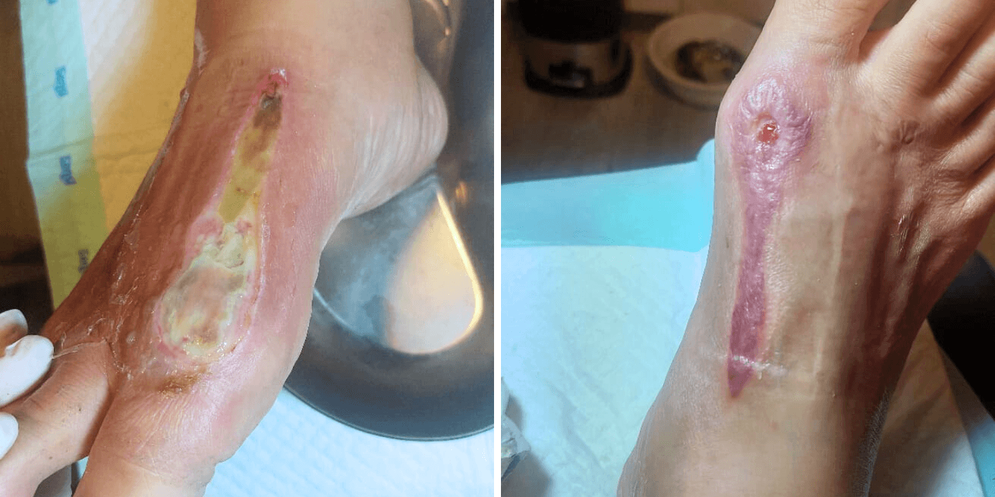Diabetic Wound Healing Made Possible with wund+™ Wound Spray