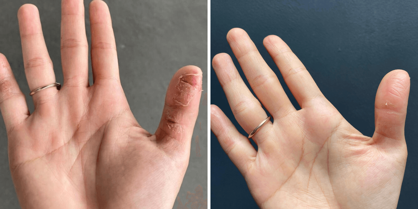 Healthy Hands Again with wund+™ Regeneration Cream