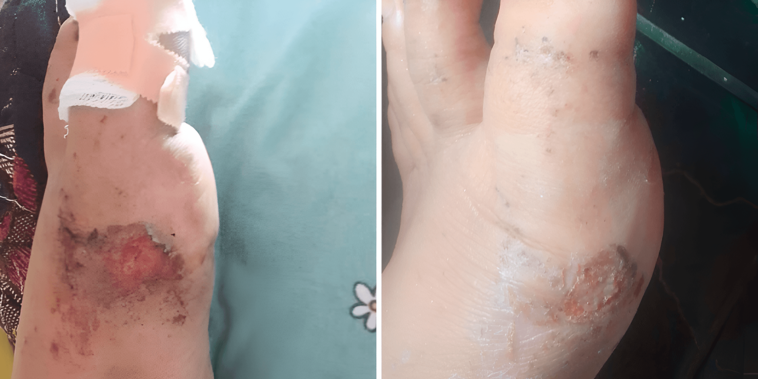 wund+™ Wound Spray Makes Wound Care Feel More Comfortable