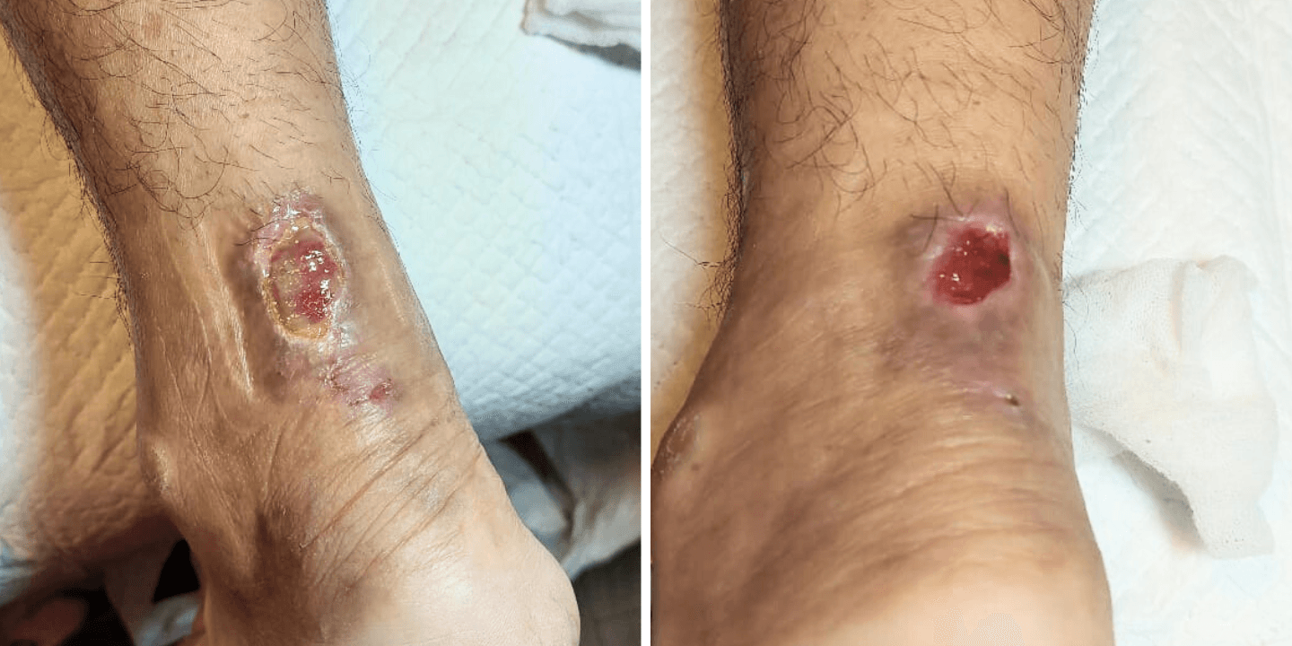 Faster Healing for Diabetic Wounds with wund+™ Wound Spray