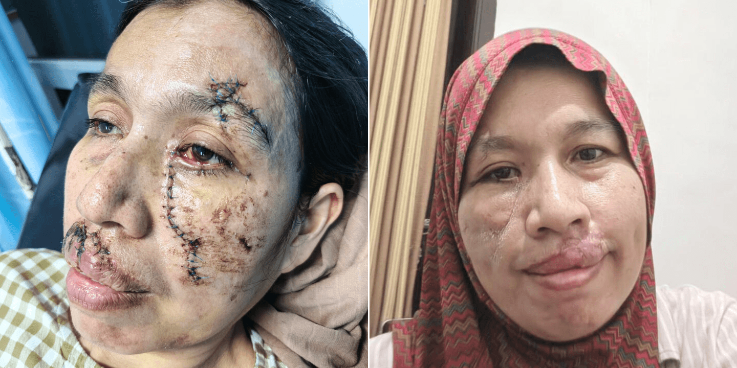 Healing After Facial Injury: From Accident Wounds to Restoring Confidence