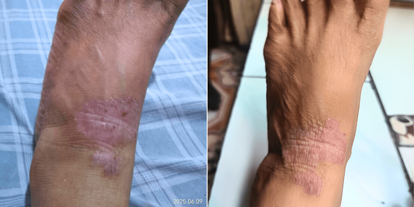 Stop Chafing from Ruining Your Day: How to Soothe Skin Abrasions and Lesions