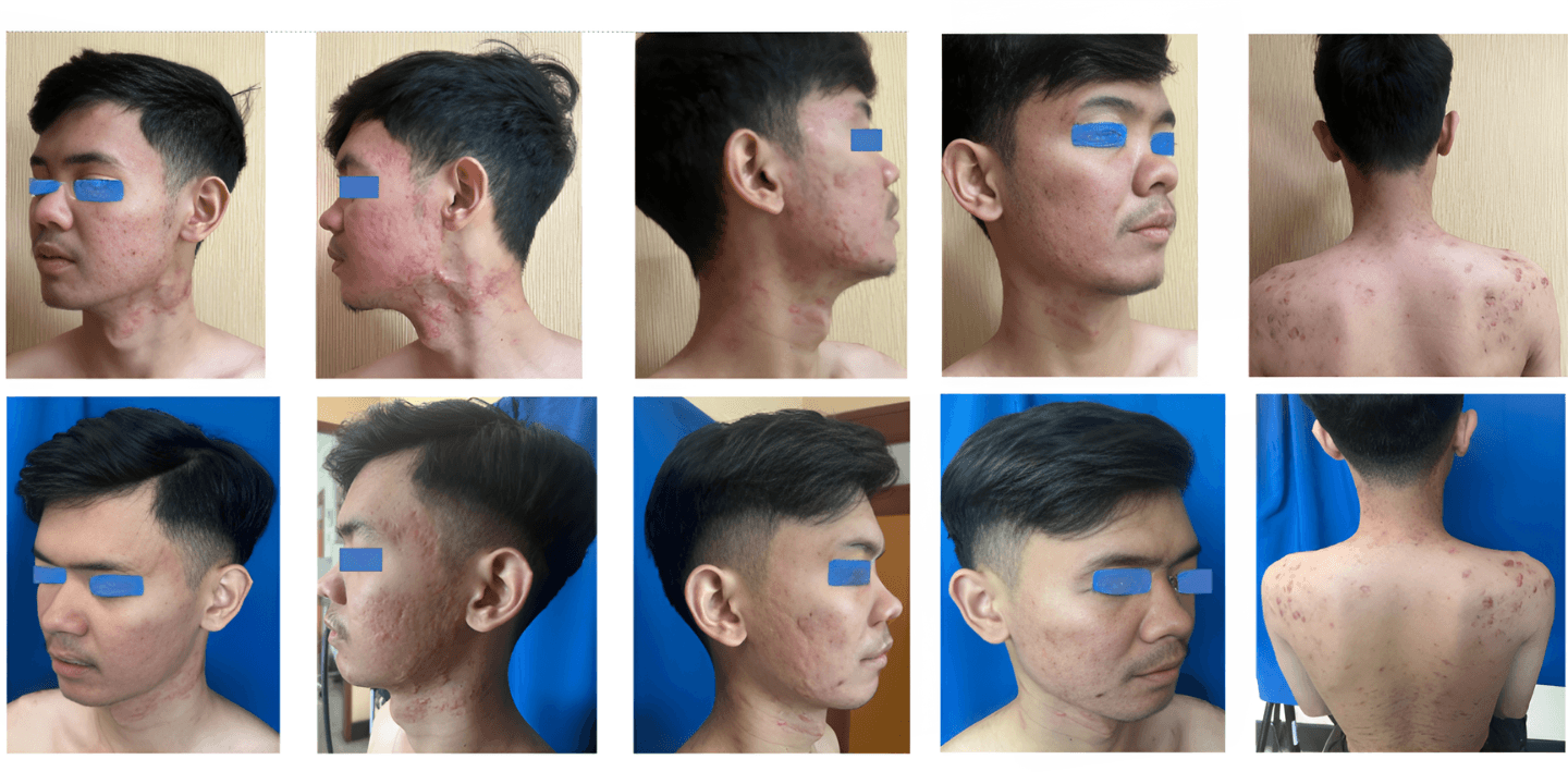 Fading Acne Marks and Redness: A Real-Life PIE and PIH Journey