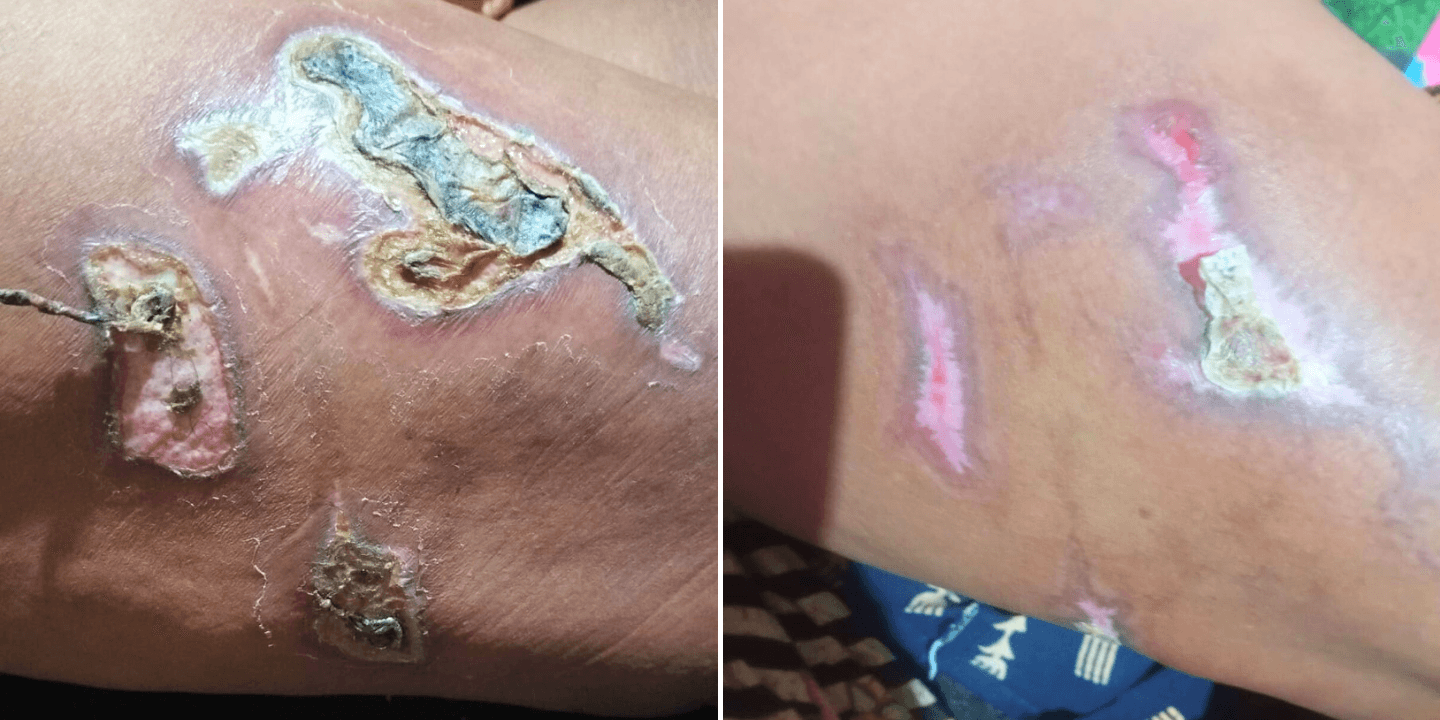 Skin Abrasion from Tight Trousers: A Recovery Story for Sensitive Skin