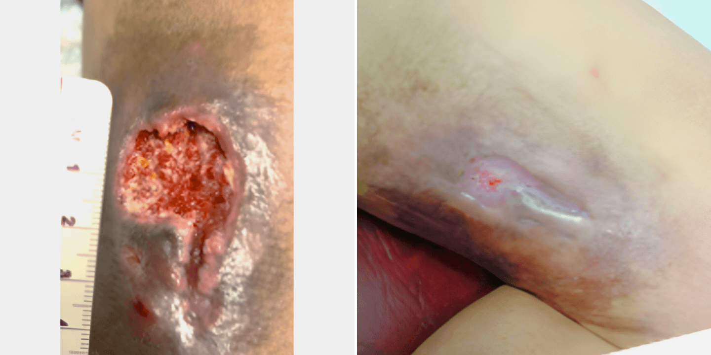 Healing a Pressure Ulcer After Stroke: A 25-Day Recovery Journey