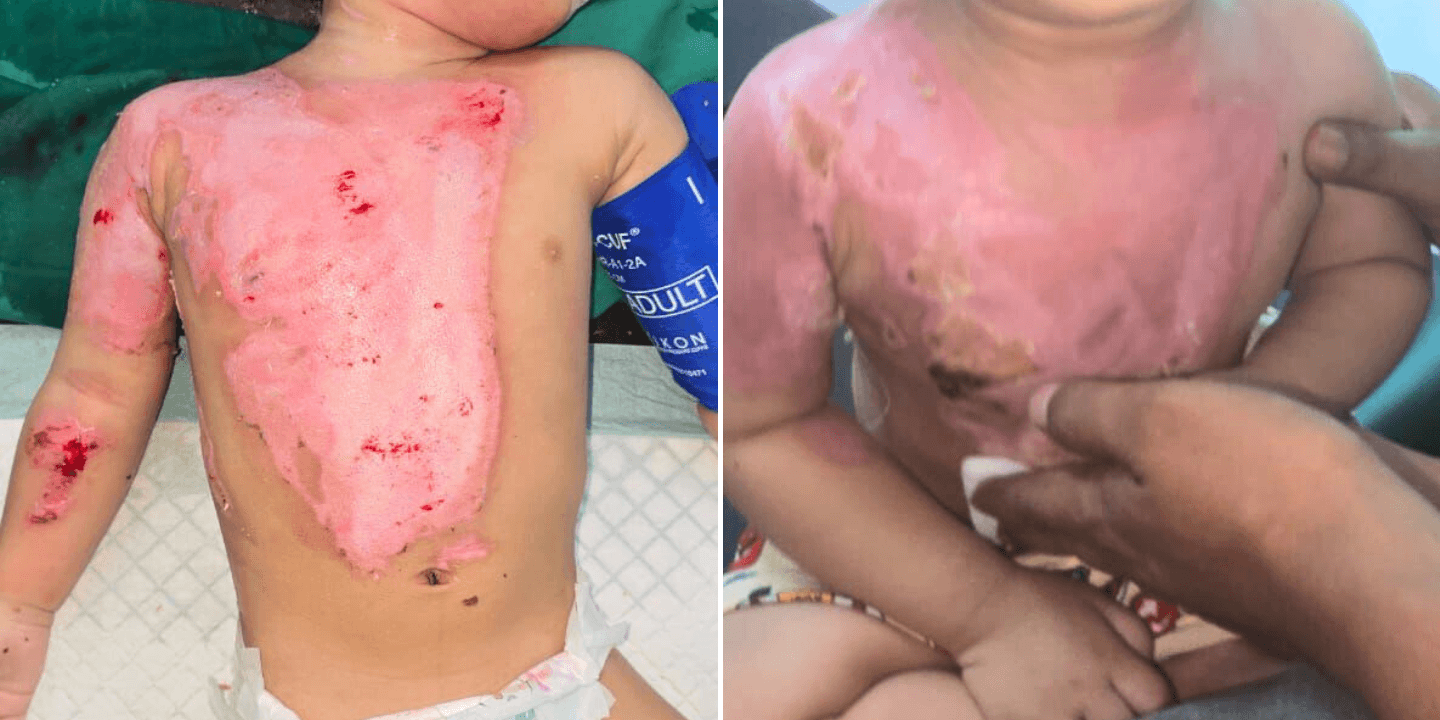 10-Day Burn Recovery: Healing a Baby’s Delicate Skin with Gentle Care